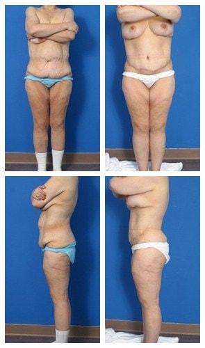 Donald W. Hause, MD body lift result — Sacramento, CA