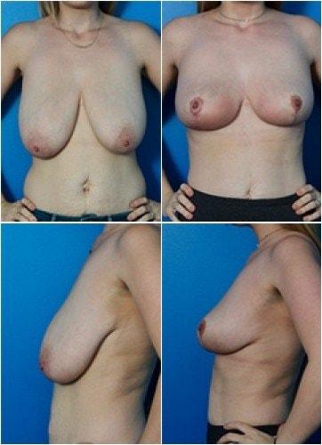 Donald W. Hause, MD breast reduction result — Sacramento, CA