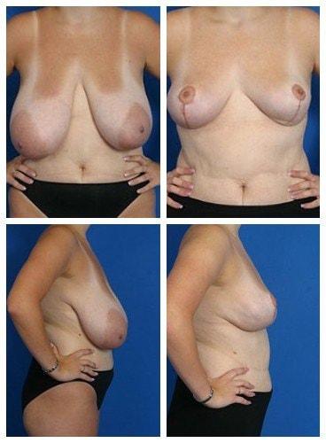Donald W. Hause, MD breast reduction result — Sacramento, CA