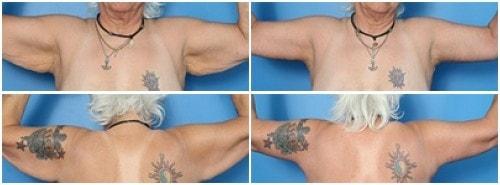 Donald W. Hause, MD arm lift result — Sacramento, CA