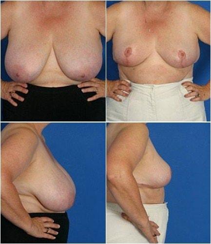 Donald W. Hause, MD breast reduction result — Sacramento, CA