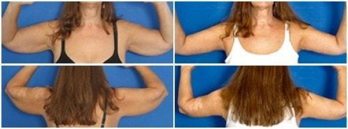Donald W. Hause, MD arm lift result — Sacramento, CA