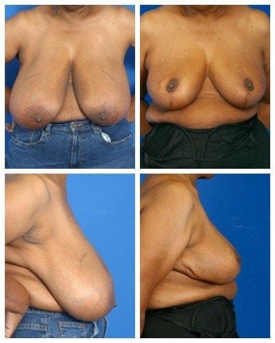 Donald W. Hause, MD breast reduction result — Sacramento, CA