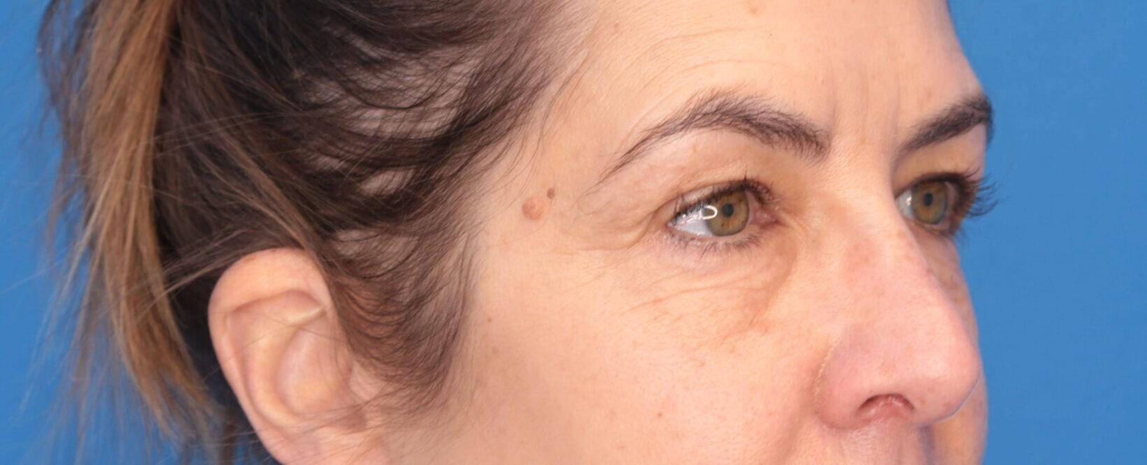 Montante Plastic Surgery & Aesthetics blepharoplasty result — Richmond, VA