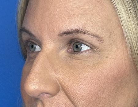 Brow Lift after at Montante Plastic Surgery & Aesthetics in Richmond, VA