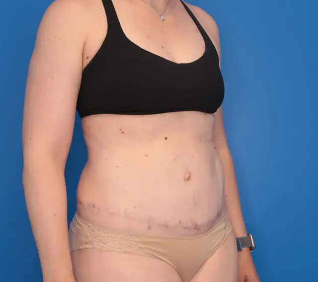 Mini Tummy Tuck after at Montante Plastic Surgery & Aesthetics in Richmond, VA