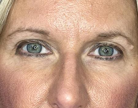 Brow Lift before at Montante Plastic Surgery & Aesthetics in Richmond, VA