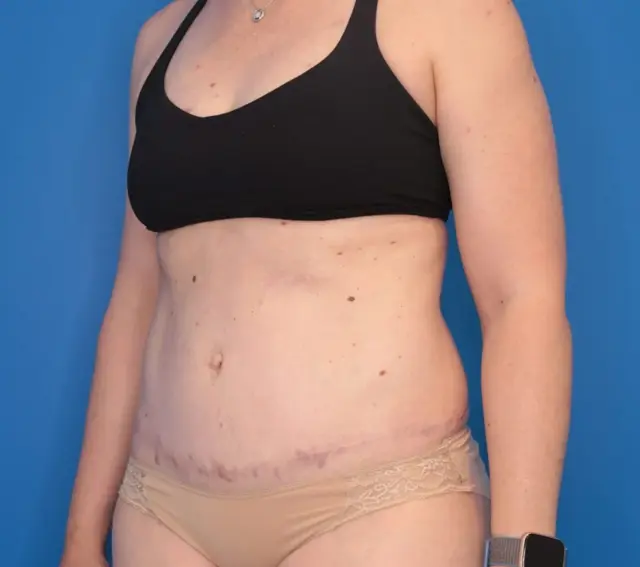 Mini Tummy Tuck after at Montante Plastic Surgery & Aesthetics in Richmond, VA