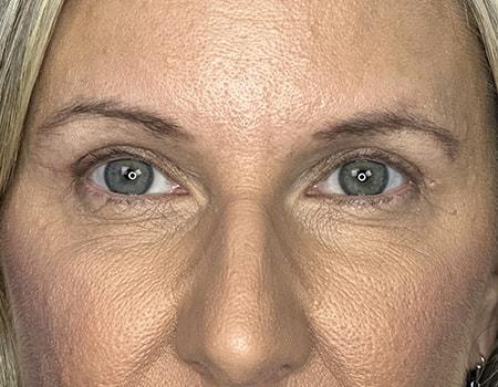 Brow Lift after at Montante Plastic Surgery & Aesthetics in Richmond, VA