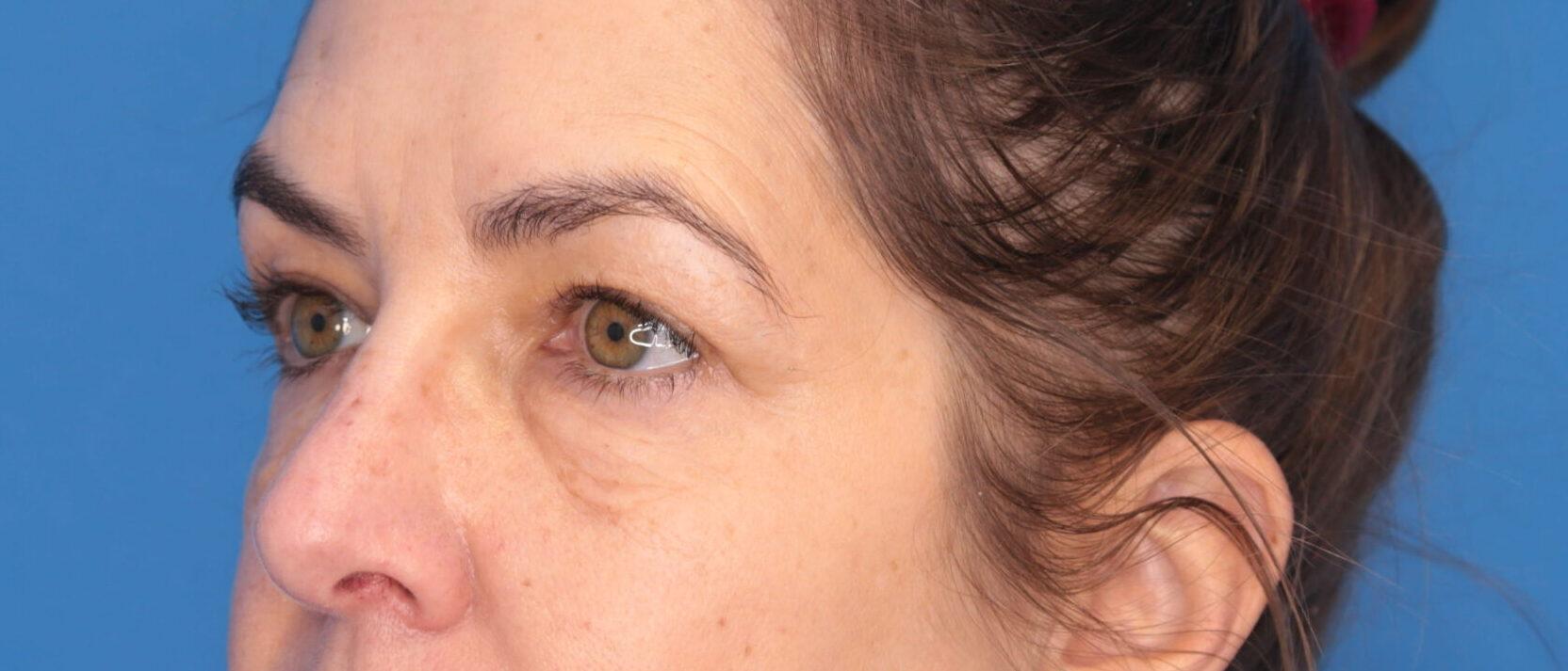 Montante Plastic Surgery & Aesthetics blepharoplasty result — Richmond, VA