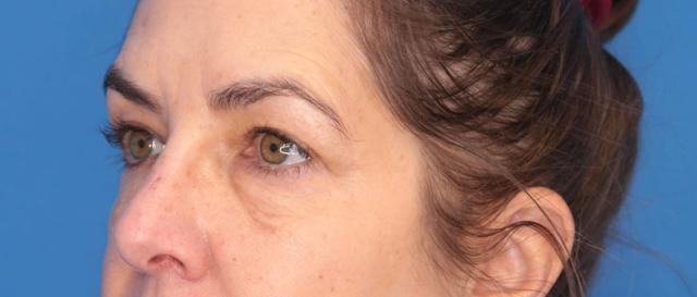 Blepharoplasty result at Montante Plastic Surgery & Aesthetics in Richmond, VA