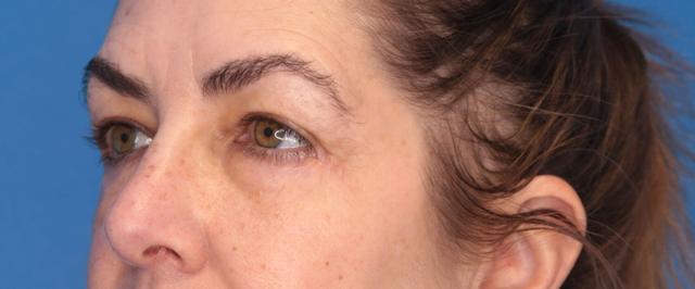 Blepharoplasty result at Montante Plastic Surgery & Aesthetics in Richmond, VA