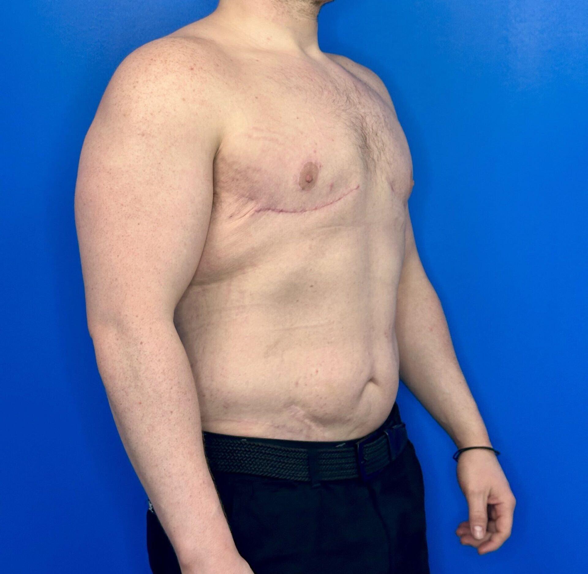 Montante Plastic Surgery & Aesthetics gynecomastia after — Richmond, VA