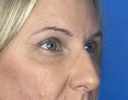 Montante Plastic Surgery & Aesthetics brow lift after — Richmond, VA