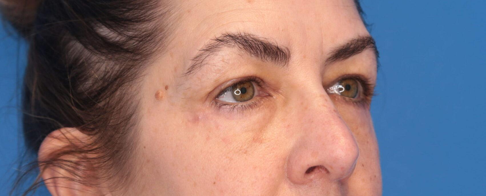 Montante Plastic Surgery & Aesthetics blepharoplasty result — Richmond, VA