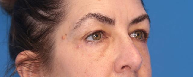 Blepharoplasty result at Montante Plastic Surgery & Aesthetics in Richmond, VA