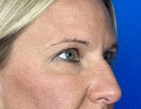 Brow Lift before at Montante Plastic Surgery & Aesthetics in Richmond, VA