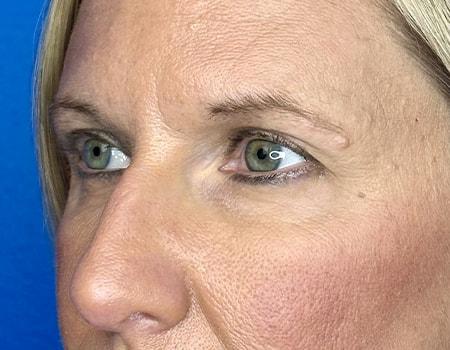 Brow Lift before at Montante Plastic Surgery & Aesthetics in Richmond, VA