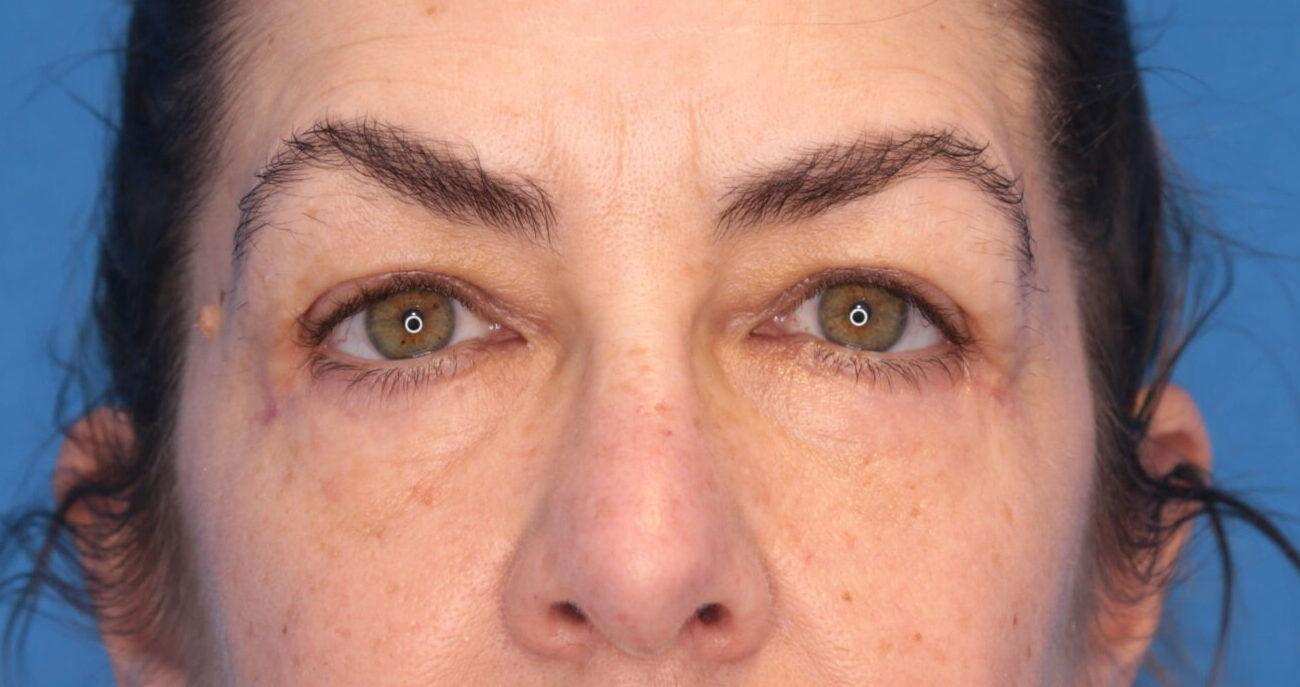 Montante Plastic Surgery & Aesthetics blepharoplasty result — Richmond, VA