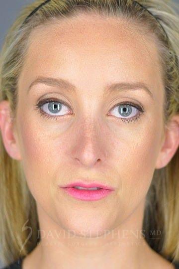 Stephens Plastic Surgery rhinoplasty after — Bellevue, WA