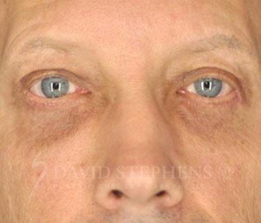 Blepharoplasty after at Stephens Plastic Surgery in Bellevue, WA