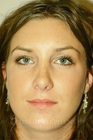 Rhinoplasty after at Stephens Plastic Surgery in Bellevue, WA