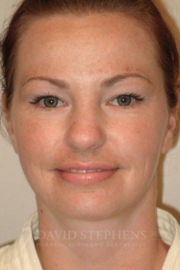 Neck Liposuction after at Stephens Plastic Surgery in Bellevue, WA