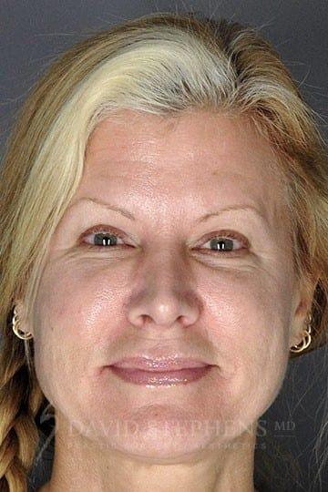 Stephens Plastic Surgery rhinoplasty after — Bellevue, WA