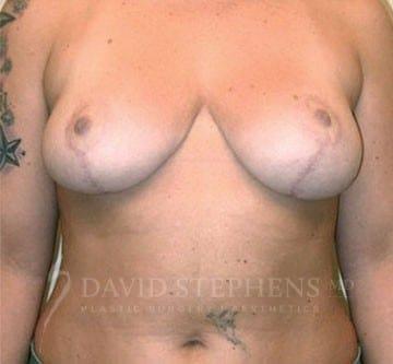 Breast Lift after at Stephens Plastic Surgery in Bellevue, WA