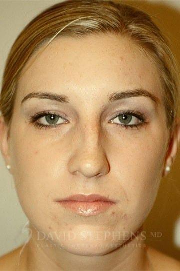 Rhinoplasty before at Stephens Plastic Surgery in Bellevue, WA