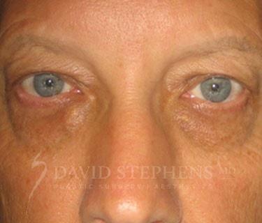 Blepharoplasty before at Stephens Plastic Surgery in Bellevue, WA
