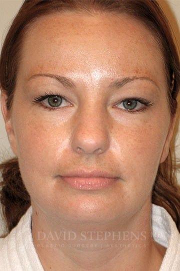 Neck Liposuction before at Stephens Plastic Surgery in Bellevue, WA