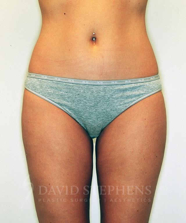 Liposuction after at Stephens Plastic Surgery in Bellevue, WA