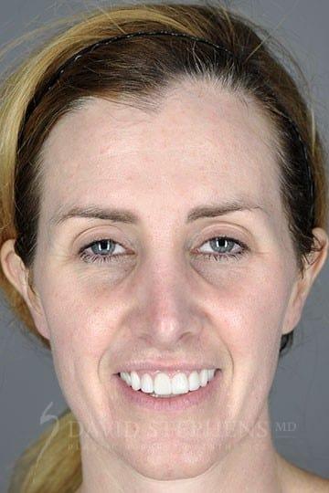 Stephens Plastic Surgery rhinoplasty after — Bellevue, WA