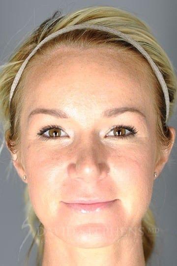 Stephens Plastic Surgery rhinoplasty after — Bellevue, WA
