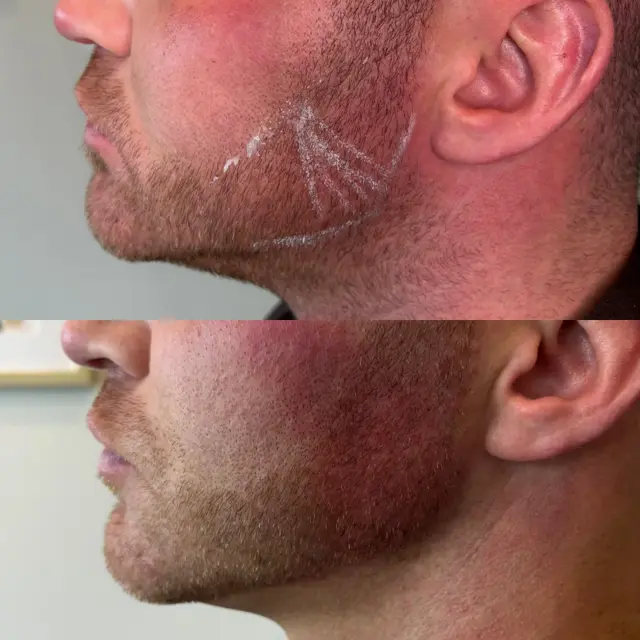 Jawline Filler result at Uniquely You Aesthetics and Wellness in Millcreek, UT