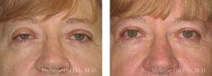 Melanie Ho Erb, MD - Laser, Cosmetic, and Oculoplastic Surgery result — Irvine, CA