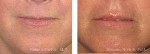 Lip Filler result at Melanie Ho Erb, MD - Laser, Cosmetic, and Oculoplastic Surgery in Irvine, CA