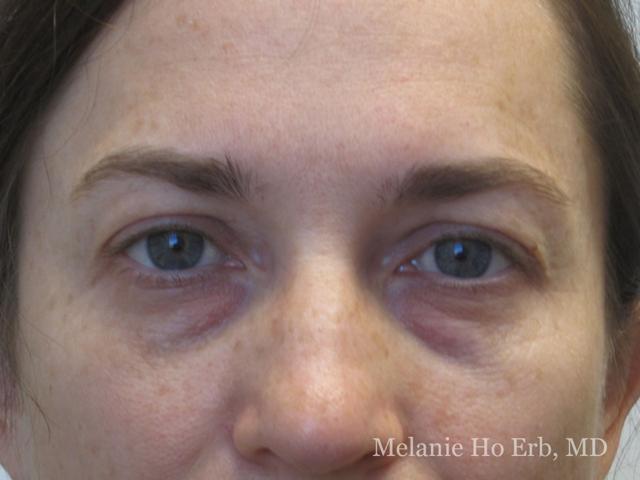 Brow Lift before at Melanie Ho Erb, MD - Laser, Cosmetic, and Oculoplastic Surgery in Irvine, CA