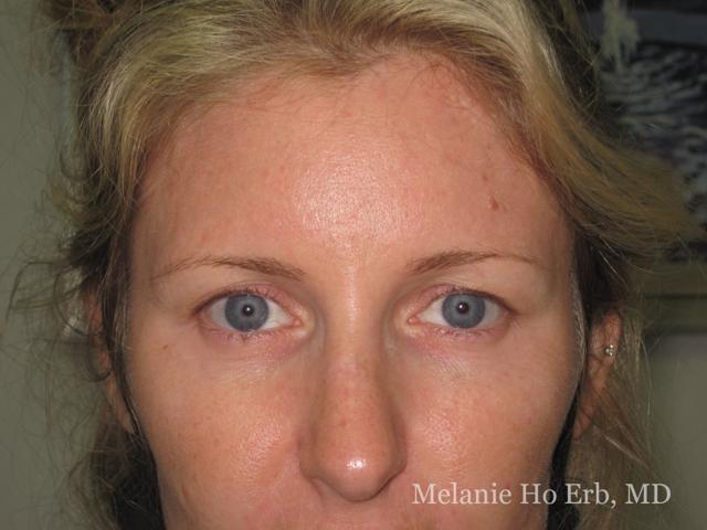 Brow Lift before at Melanie Ho Erb, MD - Laser, Cosmetic, and Oculoplastic Surgery in Irvine, CA