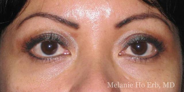 Blepharoplasty after at Melanie Ho Erb, MD - Laser, Cosmetic, and Oculoplastic Surgery in Irvine, CA