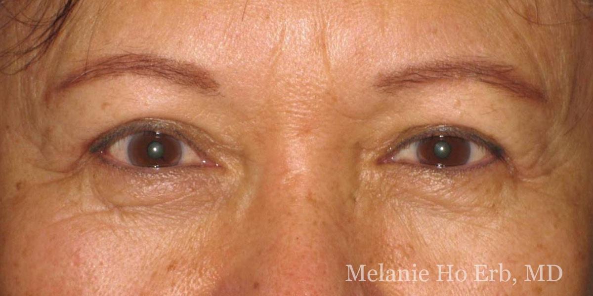 Melanie Ho Erb, MD - Laser, Cosmetic, and Oculoplastic Surgery eyelid lift after — Irvine, CA