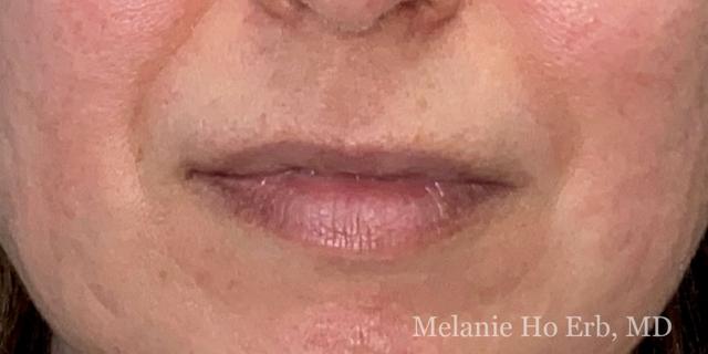 Lip Filler before at Melanie Ho Erb, MD - Laser, Cosmetic, and Oculoplastic Surgery in Irvine, CA