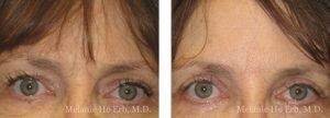 Melanie Ho Erb, MD - Laser, Cosmetic, and Oculoplastic Surgery result — Irvine, CA