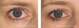 Melanie Ho Erb, MD - Laser, Cosmetic, and Oculoplastic Surgery result — Irvine, CA