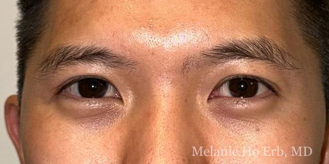 Blepharoplasty after at Melanie Ho Erb, MD - Laser, Cosmetic, and Oculoplastic Surgery in Irvine, CA