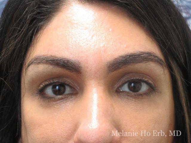 Brow Lift after at Melanie Ho Erb, MD - Laser, Cosmetic, and Oculoplastic Surgery in Irvine, CA