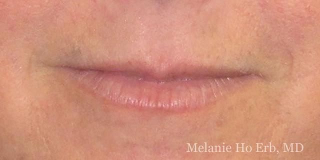 Lip Filler before at Melanie Ho Erb, MD - Laser, Cosmetic, and Oculoplastic Surgery in Irvine, CA