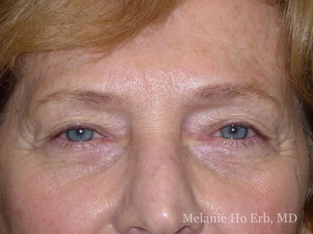 Brow Lift before at Melanie Ho Erb, MD - Laser, Cosmetic, and Oculoplastic Surgery in Irvine, CA