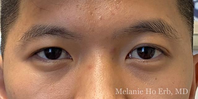 Blepharoplasty before at Melanie Ho Erb, MD - Laser, Cosmetic, and Oculoplastic Surgery in Irvine, CA